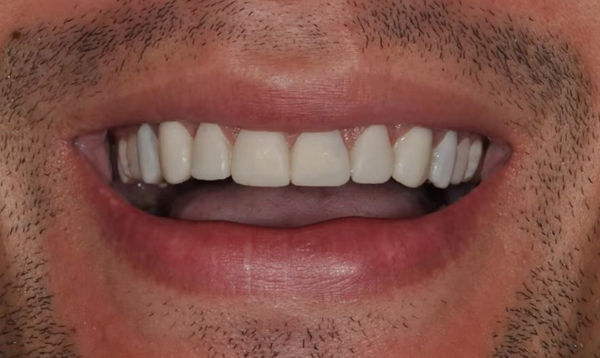Porcelain Veneers Obeid Dental Chevy Chase